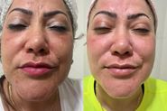 Tratamento de melasma