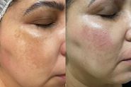 Tratamento de melasma