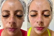 Tratamento de melasma