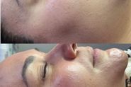 Dermaplaning + limpeza de pele