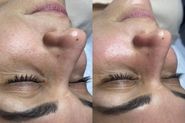 Dermaplaning + limpeza de pele