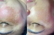 Tratamento de melasma