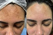 Tratamento de melasma