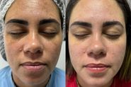Tratamento de melasma