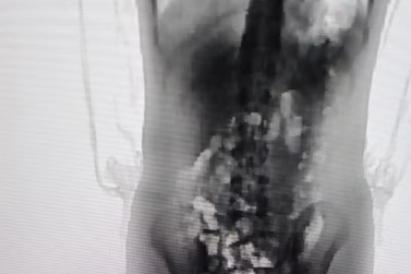 Adolescente tenta entrar em pres&iacute;dio com 32 por&ccedil;&otilde;es de 'supermaconha' dentro do corpo