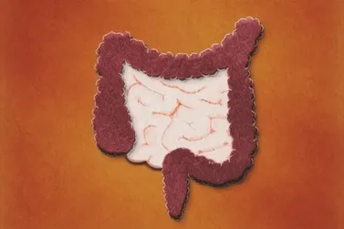 Veja hábitos que podem evitar 30% dos casos de câncer de intestino