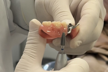 Servi&ccedil;o gratuito de pr&oacute;teses dent&aacute;rias transforma sorriso de pacientes do SUS em Gramado