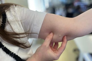 Tim&oacute;teo sedia treinamento regional para inser&ccedil;&atilde;o do contraceptivo Implanon no SUS