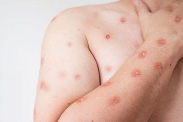 Avan&ccedil;o de casos de Mpox em Rond&ocirc;nia abre alerta em Mato Grosso