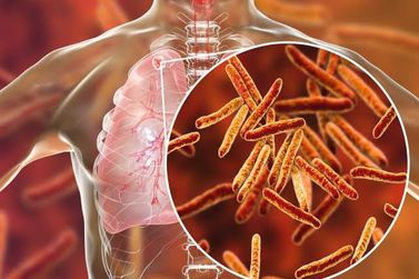 Estado do RJ lança pacto para combate à mortalidade por tuberculose