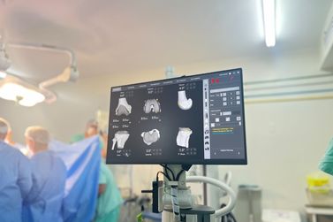 Santa Casa de Passos realiza 1&ordf; cirurgia rob&oacute;tica ortop&eacute;dica com acesso pelo SUS