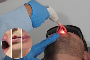 De feridas &agrave; cicatriza&ccedil;&atilde;o: como o herpes labial se manifesta e pode ser tratado