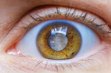 Agosto Cinza alerta para preven&ccedil;&atilde;o e tratamento da catarata