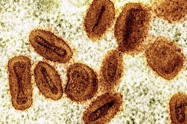 Mpox: casos sobem para oito em Rond&ocirc;nia; crian&ccedil;a est&aacute; entre infectados