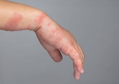 Novas notifica&ccedil;&otilde;es est&atilde;o em queda e pacientes apresentam boa evolu&ccedil;&atilde;o