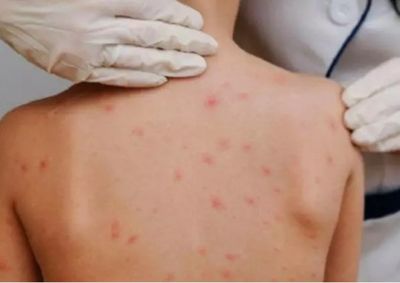 Munic&iacute;pio contabiliza 16 casos suspeitos em tr&ecirc;s unidades de educa&ccedil;&atilde;o infantil e amplia a&ccedil;&otilde;es de monitoramento, orienta&ccedil;&atilde;o e preven&ccedil;&atilde;o