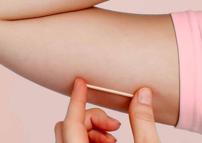 M&eacute;todo contraceptivo de longa dura&ccedil;&atilde;o deve come&ccedil;ar a ser oferecido nos pr&oacute;ximos meses ap&oacute;s a conclus&atilde;o da capacita&ccedil;&atilde;o dos profissionais
