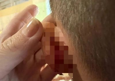 Menino relatou que ferimento foi causado por pux&atilde;o do suspeito; homem e a m&atilde;e da v&iacute;tima j&aacute; eram investigados por agress&otilde;es anteriores.