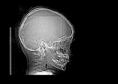 Crian&ccedil;a estava no carro com os pais quando foi atingida por uma garrafa de vidro arremessada durante aglomera&ccedil;&atilde;o; fam&iacute;lia busca identificar o respons&aacute;vel