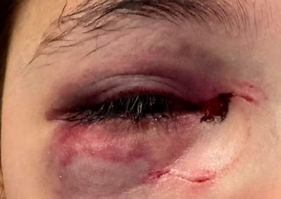 Menina segue realizando exames, apresenta incha&ccedil;o nos olhos e fam&iacute;lia relata momentos dif&iacute;ceis enquanto espera por Justi&ccedil;a