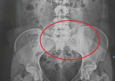 Paciente de 23 anos passou por nova cirurgia ap&oacute;s tr&ecirc;s meses de dores e exames apontarem a presen&ccedil;a de corpo estranho
