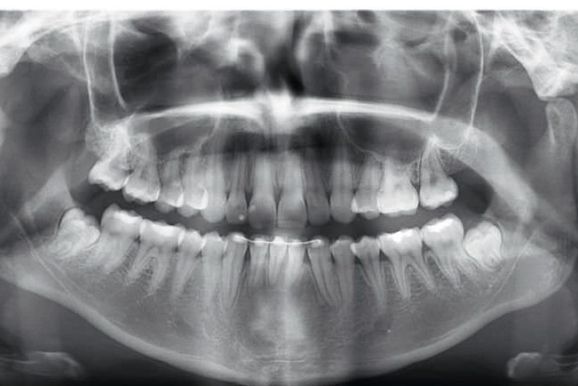 Radiografia panor&acirc;mica: o que voc&ecirc; deve saber antes de realizar esse exame