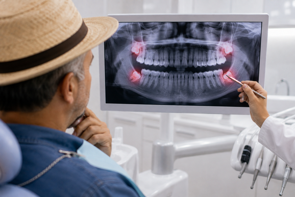 O famoso siso precisa mesmo ser arrancado? Dentista explica