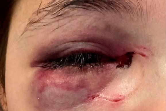 Pai de menina atingida por uma garrafa em Toledo atualiza o estado de sa&uacute;de da filha