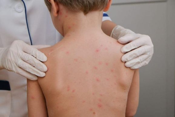 Mortes por meningite na RPT j&aacute; superam todo o registrado em 2025