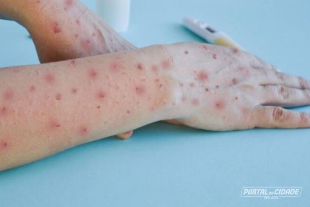 Conhecida como var&iacute;ola do macaco a Mpox &eacute; uma erup&ccedil;&atilde;o na pele, semelhante a bolhas ou feridas e podem durar de duas a quatro semanas. 
