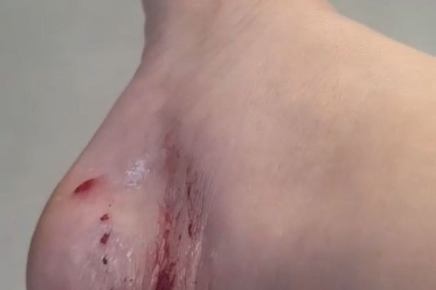Mordida por cachorro, moradora ouve que s&oacute; pode tomar vacina se ele morrer