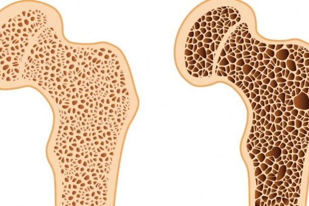 Osteoporose causa dor cr&ocirc;nica tornando nossos ossos porosos, fr&aacute;geis e quebradi&ccedil;os. 