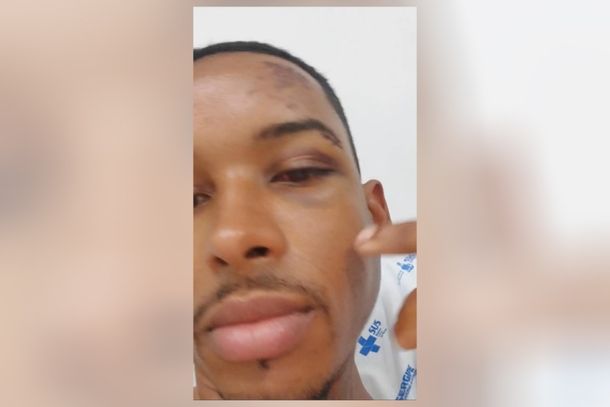 Rafael Cruz mostra perna p&oacute;s-cirurgia e refor&ccedil;a pedido de apoio em vaquinha