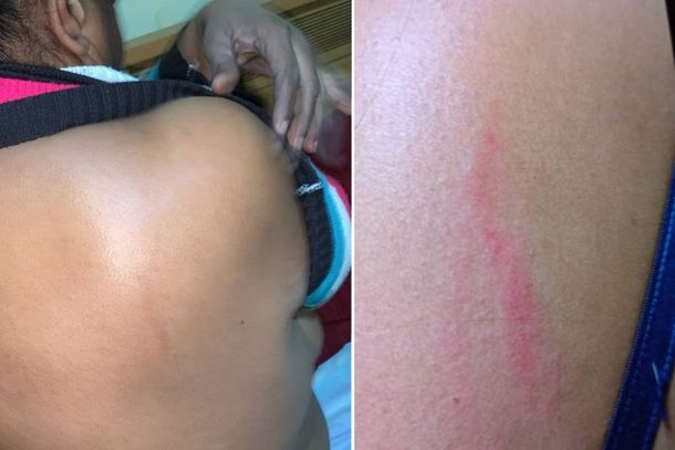 A v&iacute;tima, de 38 anos, mostra as marcas deixadas pela agress&atilde;o quando foi &agrave; ala de fumantes do CHSL 