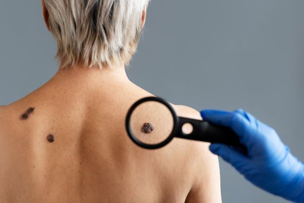 Observar regularmente as pintas e manchas do corpo ajuda na preven&ccedil;&atilde;o 