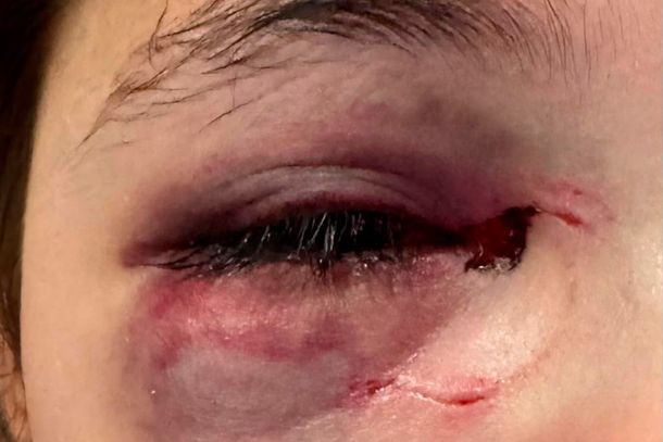 Pai de menina atingida por uma garrafa em Toledo atualiza o estado de sa&uacute;de da filha