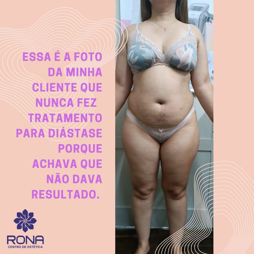 Diástase abdominal, um guia para saberes mais sobre o assunto