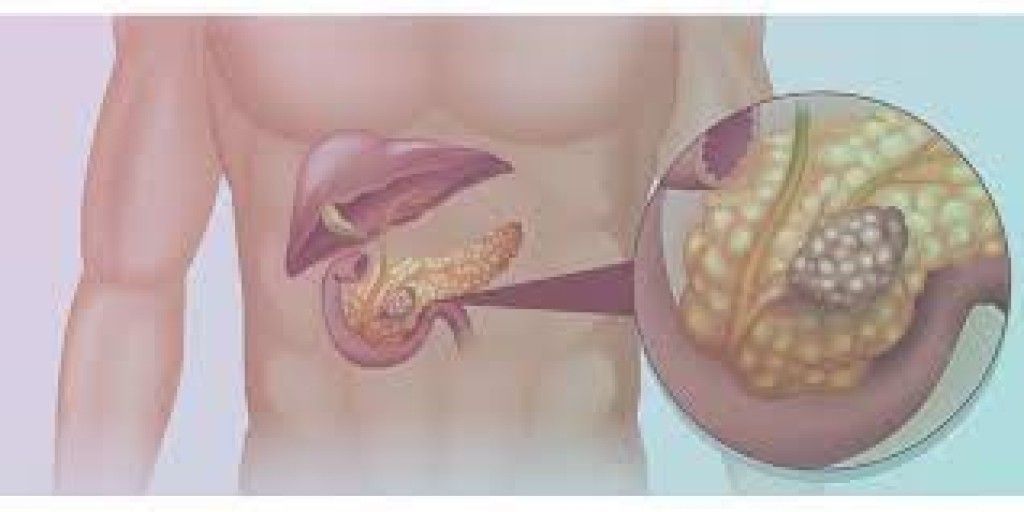TecMundo no LinkedIn: Câncer de pâncreas: vacina destruiu células  cancerígenas em primeiro teste